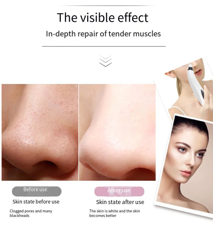 Pore Suction Pro